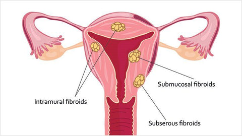 WHAT ARE FIBROIDS?